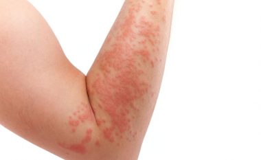 Varianti Omicron: Cila është simptoma e lëkurës që duhet të keni kujdes