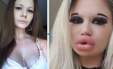 Vajza me buzët më të mëdha në botë, rrezikon t’i “shpërthejnë”