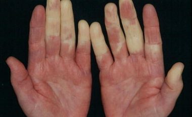 Nëse duart dhe këmbët ju mpihen e ndryshojnë ngjyrë kur është ftohtë, vuani nga kjo sëmundje