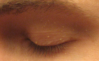 Pikat e bardha dhjamore në sy, çfarë janë dhe si t’i zhdukim përgjithmonë