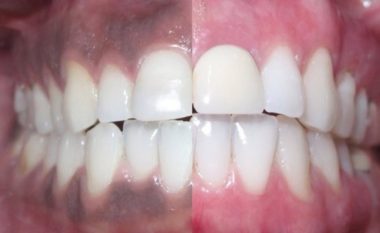 Mos e anashkaloni, problemet e shëndetit që iu zbulojnë mishrat e errët të dhëmbëve
