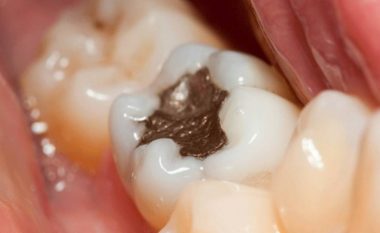 A keni mbushje të tilla në dhëmballë? Stomatologu zbulon pse duhet t’i zëvendësoni menjëherë