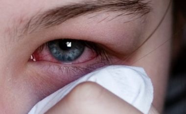 A keni dëgjuar për gripin e syrit? Këto janë simptomat dhe masat parandaluese
