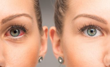 Keni gjurmë gjaku në sy? Cilat janë shkaqet dhe si të parandaloni plasjen e kapilarëve?