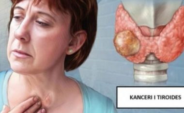 Dallohen menjëherë, 3 ndryshme në trup që paralajmërojnë kancerin e tiroides