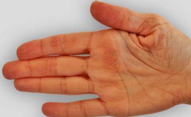 Kontrolloni herë pas here pëllëmbët e duarve, kjo shenjë paralajmëron sëmundjen e rëndë
