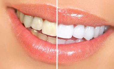 Kontrolloni se çfarë po bëni gabim: 6 arsyet pse dhëmbët kthehen në të verdhë dhe si ta parandaloni atë