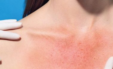 Këto simptoma ju tregojnë se jeni alergjik nga dielli, kush rrezikohet më shumë dhe si të mbroheni