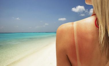 Jeni djegur nga dielli në plazh? 4 produktet që nuk duhet t’i përdorni kurrë në lëkurën e skuqur