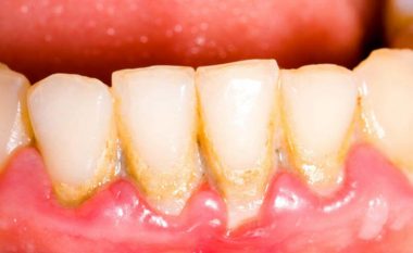 Ja si të shpëtoni njëherë e mirë prej ngjyrës së verdhë të dhëmbëve