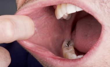 Kanceri oral, nga dhëmbë që lëvizin te shqetësimi në vesh, shenjat që tregojnë se keni një masë tumorale në gojë