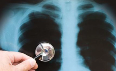 OBSH ngre alarmin, tuberkulozi po rikthehet mbarë botën