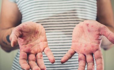 Pika të kuqe në duar, këmbë dhe gojë, çfarë sëmundje paralajmërojnë