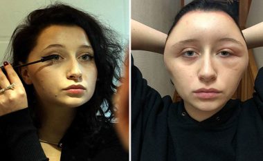 Kimikati në bojën e flokëve i rrezikon jetën 19-vjeçares, si u zgjua me kokën dy-fish më të madhe (FOTO LAJM)