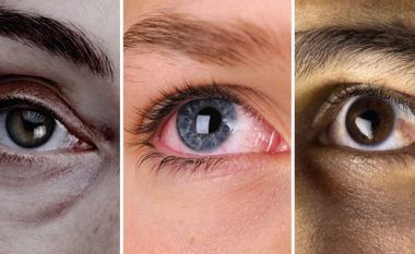 Keni njolla në sy? Ja çfarë duhet të dini patjetër!