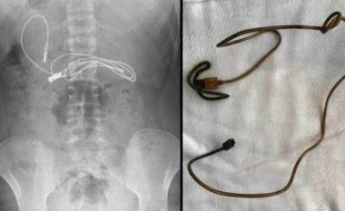 15-vjeçari shkon me dhimbje të forta në spital, mjekët shokohen kur zbulojnë çfarë kishte brenda në stomak (FOTO LAJM)