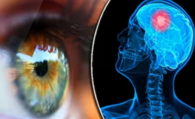 Simptomat e tumorit të trurit, 10 shenja të pazakonta që mund të shfaqen në sy dhe në fytyrë