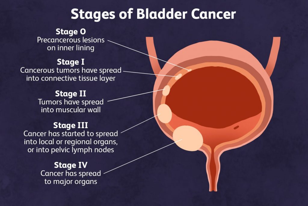 Bladder Cancer : Causes , Symptoms , Diagnosis , Signs and Treatment Options