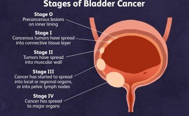 Bladder Cancer : Causes , Symptoms , Diagnosis , Signs and Treatment Options