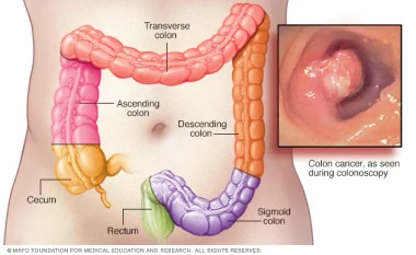 What are Symptoms of Colorectal Cancer , how to Spot it and Treatment