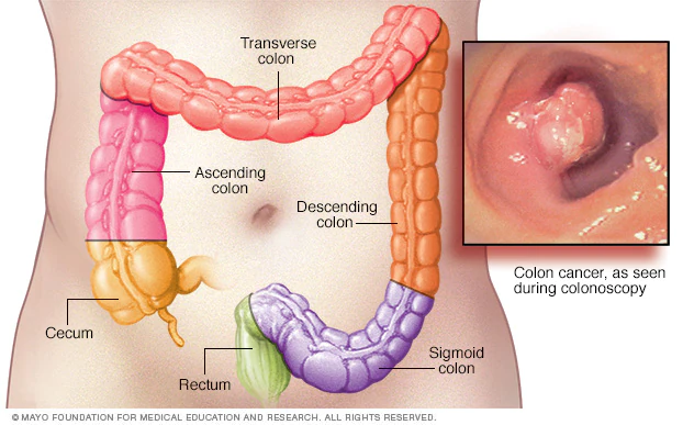 What are Symptoms of Colorectal Cancer , how to Understand it and Treatment 