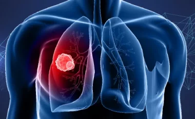 What is Lung Cancer , Symptoms and Treatment