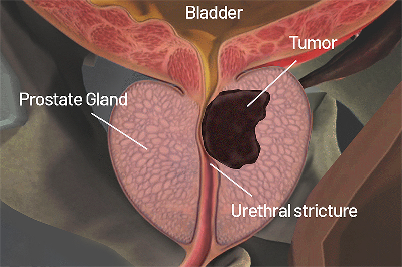 What are the Symptoms of Prostate Cancer ? How to Spot and Treat the Disease