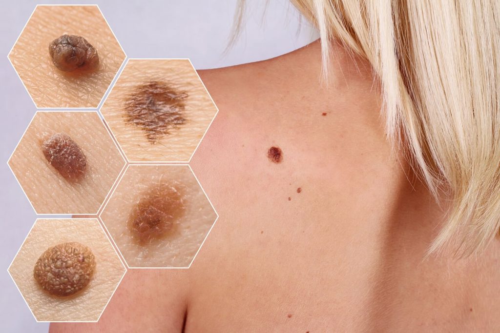 What are the Symptoms of Skin Cancer ? How to Spot and Treat the Disease