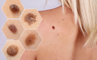 What are the Symptoms or Signs of Skin Cancer ? How to Spot and Treat the Disease