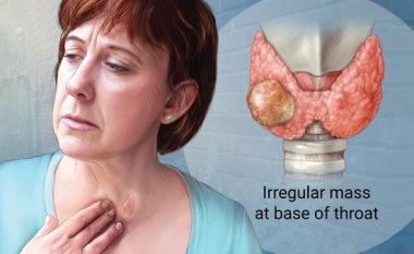 Thyroid Cancer : Types , Symptoms , Diagnosis , and Treatment Options