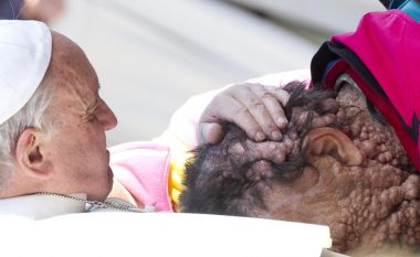 Vdes njeriu me fytyrë të deformuar që përqafoi Papa në 2013
