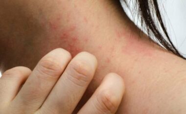 Cilat janë simptomat e alergjisë ndaj penicilinës, ja kujdesi që ju duhet