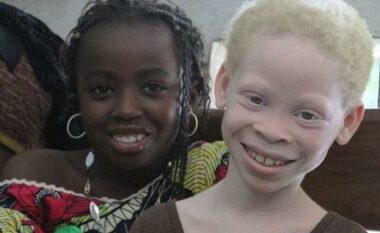 13 Qershor – Dita Botërore e Ndërgjegjësimit për Albinizmin