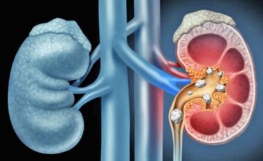 Si të përshpejtoni nxjerrjen e gurëve të veshkave nga trupi! Këshillat që ju nevojiten, ja kur duhet t’i drejtoheni mjekut