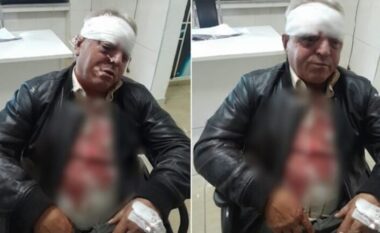 EMRI/ Dhunohet barbarisht punonjësi i Ndërmarrjes së Pastrimit në Vlorë, i rrezikohet shikimi në syrin e djathtë