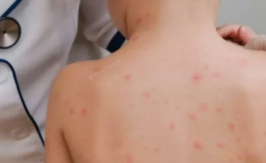 “Shpërthen” fruthi brenda një kopshti në Tiranë, 15 fëmijë të prekur