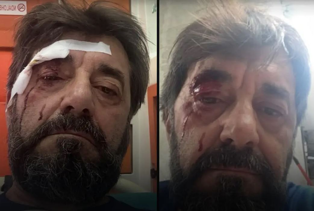FOTO Dhunohet Ilir Demalia  analisti kallëzon në polici  Më sulmuan dy persona 